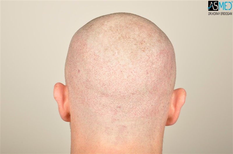 NORWOOD2 3705-grafts-FUE operation V2__DSC9385aaa
