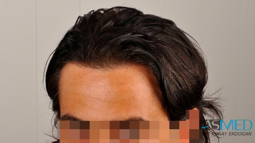Norwood3 2000-grafts-FUE-800-grafts-FUE 100e687c