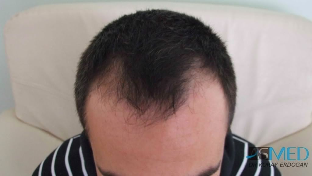 Norwood3 2000-grafts-FUE-800-grafts-FUE 15a31814