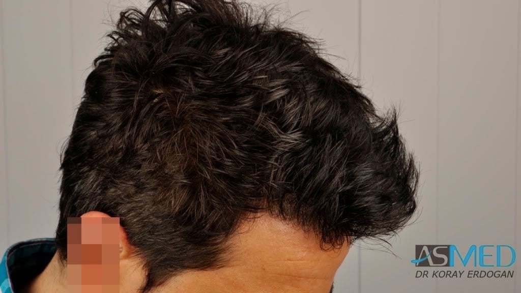Norwood3 2000-grafts-FUE-800-grafts-FUE 1842fd59