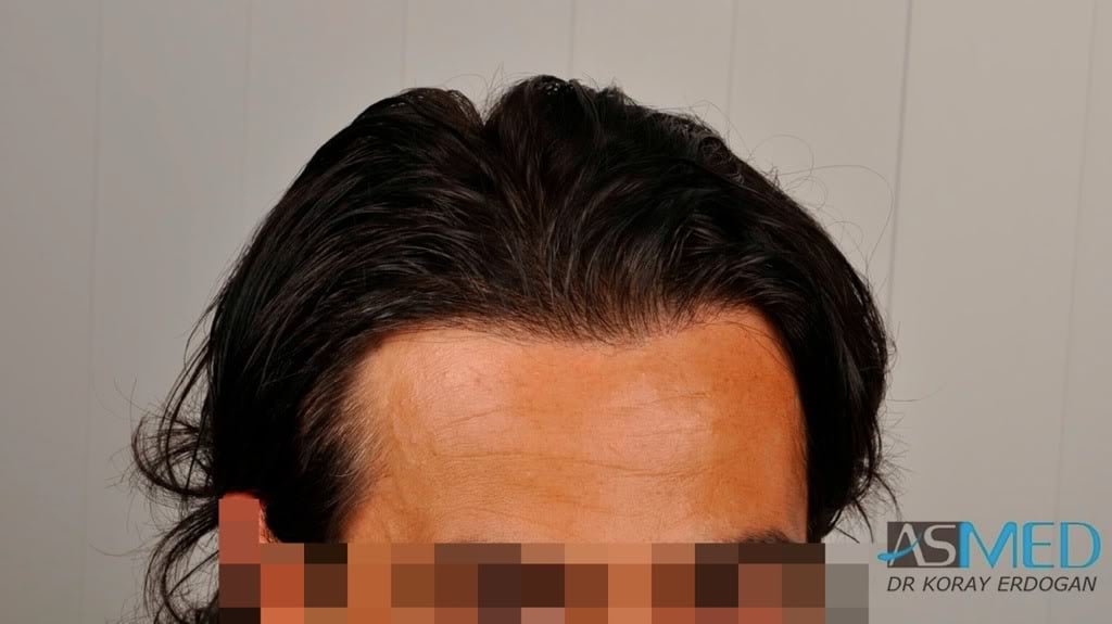 Norwood3 2000-grafts-FUE-800-grafts-FUE 1bd59b5d