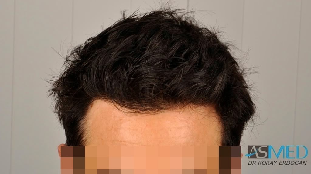 Norwood3 2000-grafts-FUE-800-grafts-FUE 26f98edd