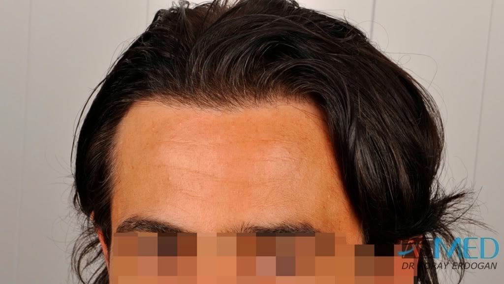 Norwood3 2000-grafts-FUE-800-grafts-FUE 2b64c946