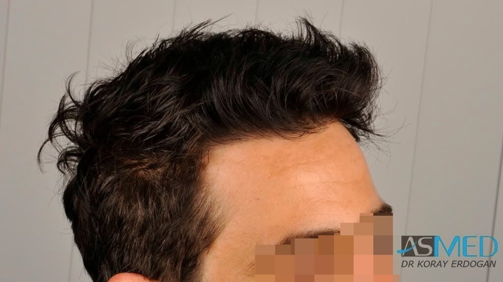 Norwood3 2000-grafts-FUE-800-grafts-FUE 32a68f0e
