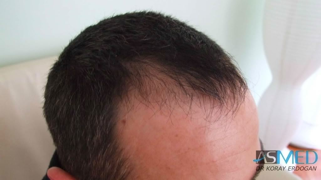 Norwood3 2000-grafts-FUE-800-grafts-FUE 398b5215