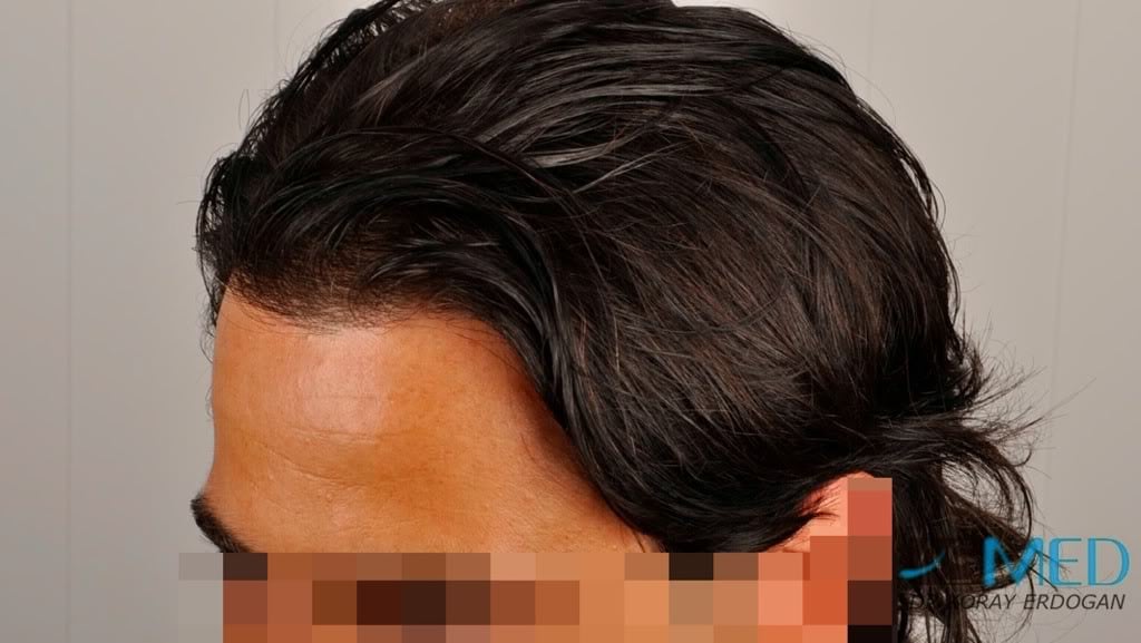 Norwood3 2000-grafts-FUE-800-grafts-FUE 53e4b744