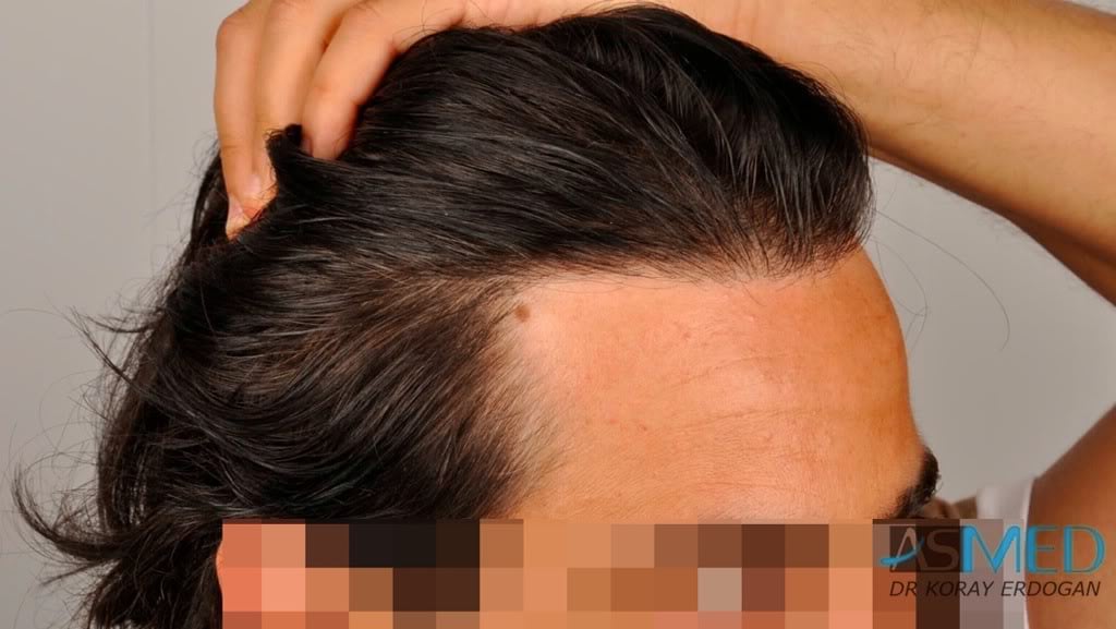 Norwood3 2000-grafts-FUE-800-grafts-FUE 624459eb