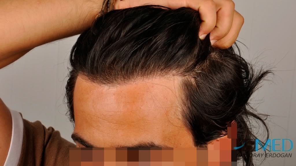 Norwood3 2000-grafts-FUE-800-grafts-FUE 72631ff8