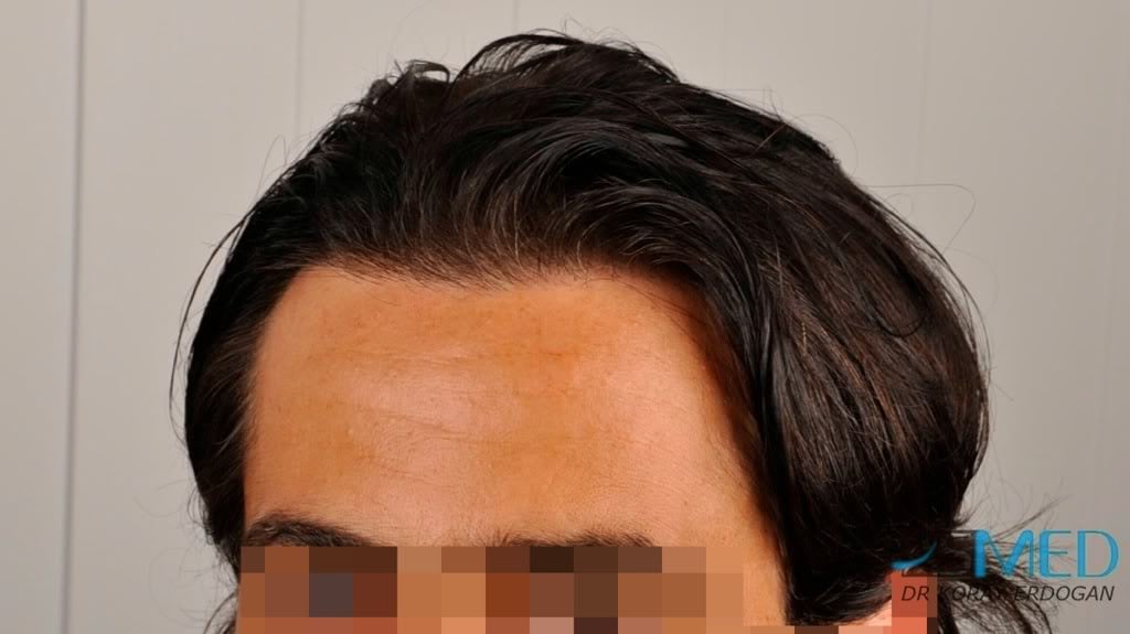 Norwood3 2000-grafts-FUE-800-grafts-FUE 752af90f