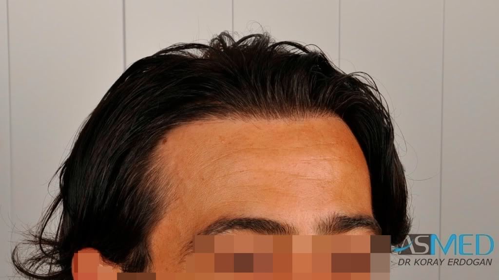 Norwood3 2000-grafts-FUE-800-grafts-FUE 7e12db86