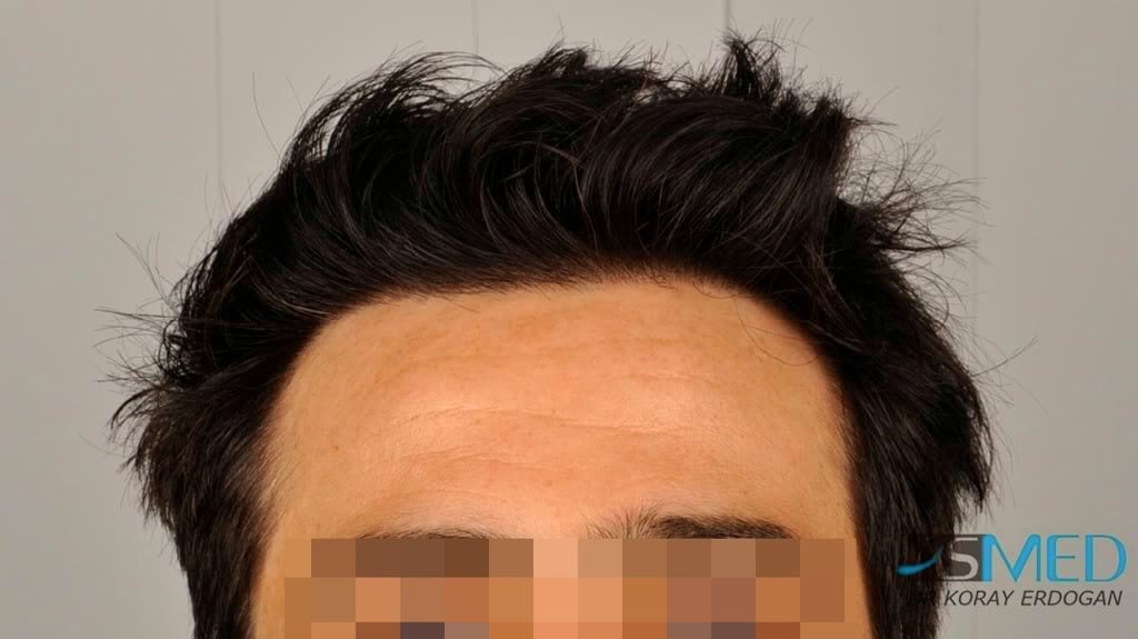 30+ 2000 Grafts Hair Transplant Cost Pics