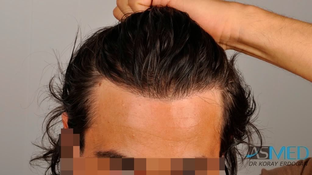 Norwood3 2000-grafts-FUE-800-grafts-FUE d7a934ce