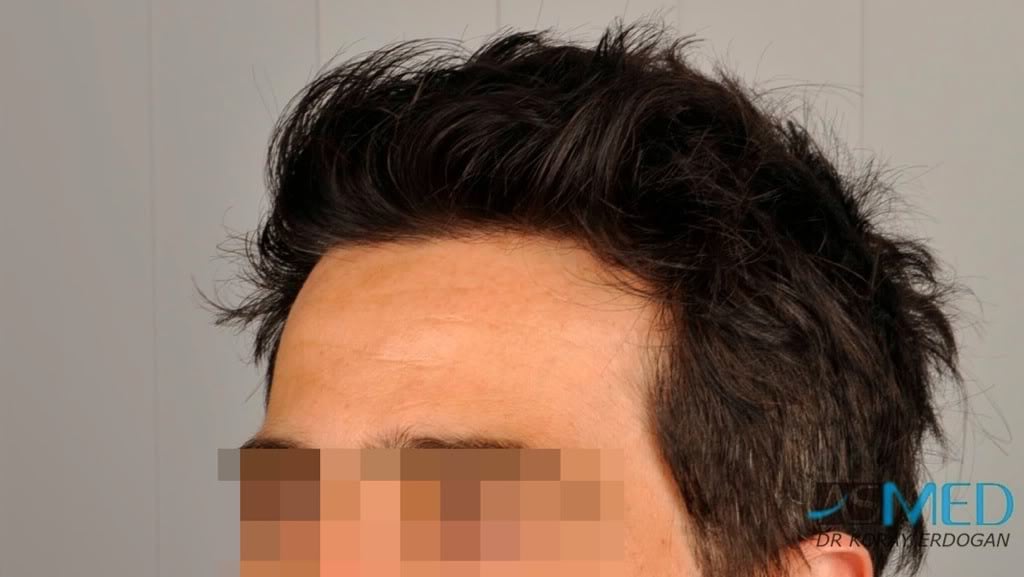 Norwood3 2000-grafts-FUE-800-grafts-FUE e47acad9