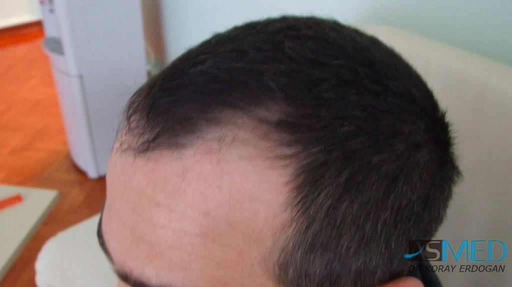 Norwood3 2000-grafts-FUE-800-grafts-FUE e4abbf52