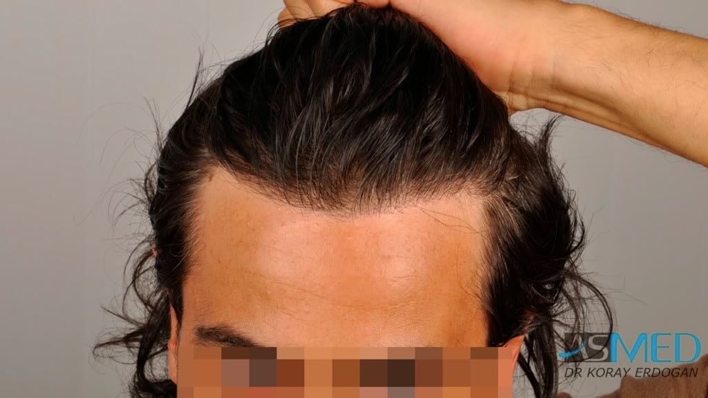 Norwood3 2000-grafts-FUE-800-grafts-FUE f4ed62ed
