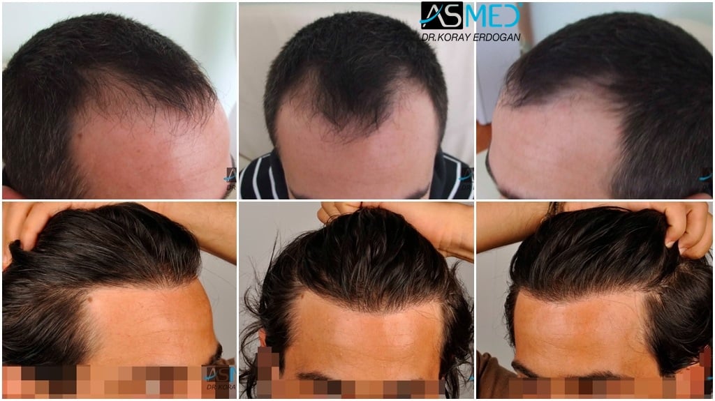 Norwood 3 Signs  Hair Transplant Results  Natural Transplants