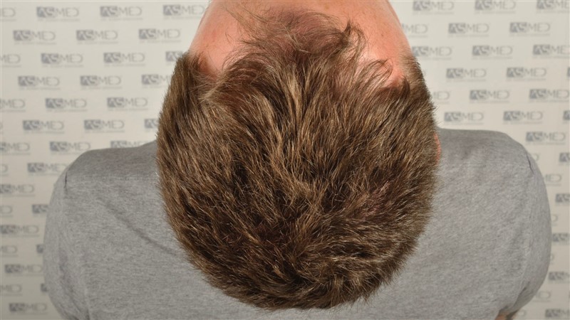 Norwood3 2004-grafts-FUE before before2 _DSC9602