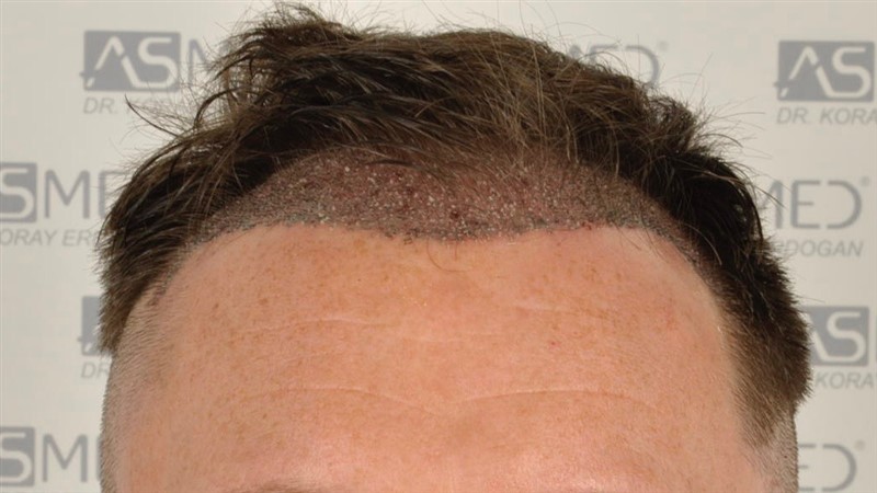 Norwood3 2004-grafts-FUE operation op2 1
