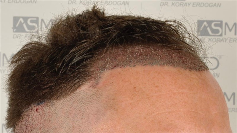 Norwood3 2004-grafts-FUE operation op2 2