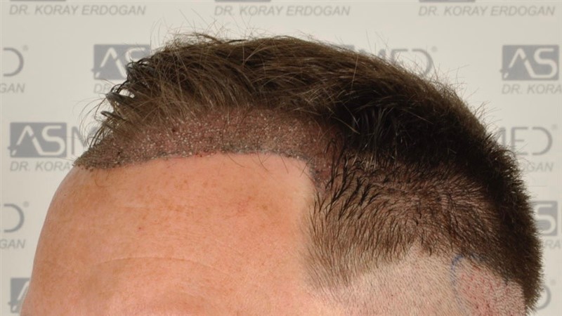 Norwood3 2004-grafts-FUE operation op2 3