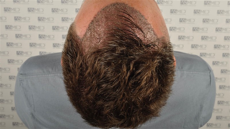 Norwood3 2004-grafts-FUE operation op2 4