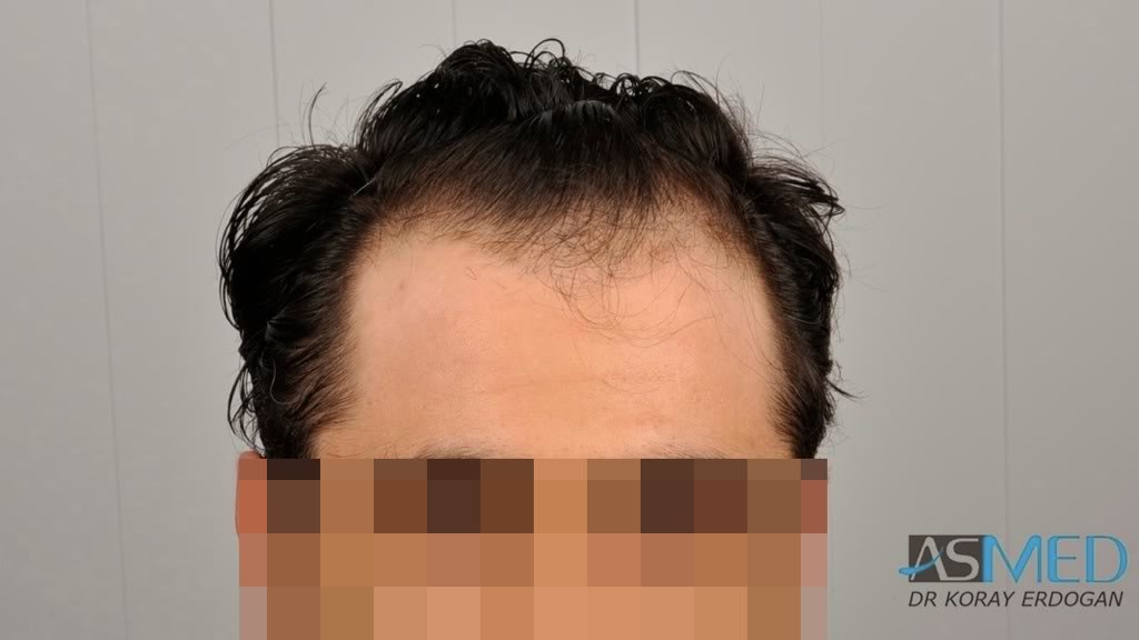 Norwood3 2100-grafts-FUE 26cc3100
