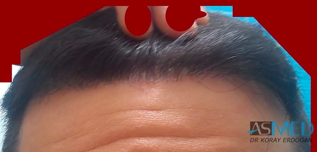 Norwood3 2100-grafts-FUE 2f4e8c54