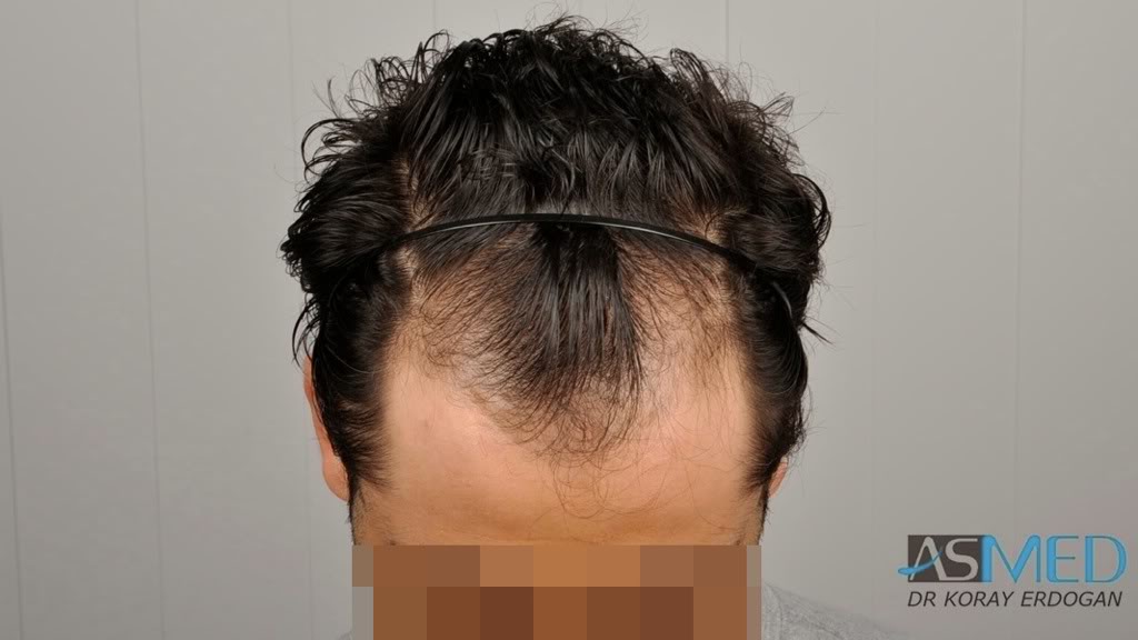 Norwood3 2100-grafts-FUE 30d1ef6a