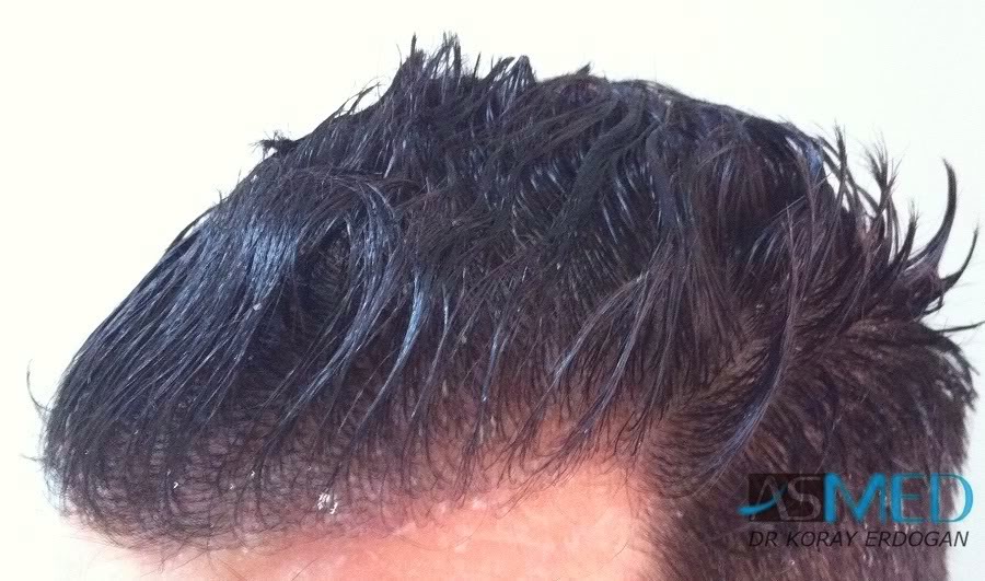 Norwood3 2100-grafts-FUE 3786d0b9