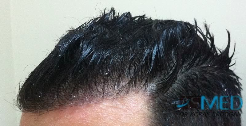 Norwood3 2100-grafts-FUE 45b2bb89