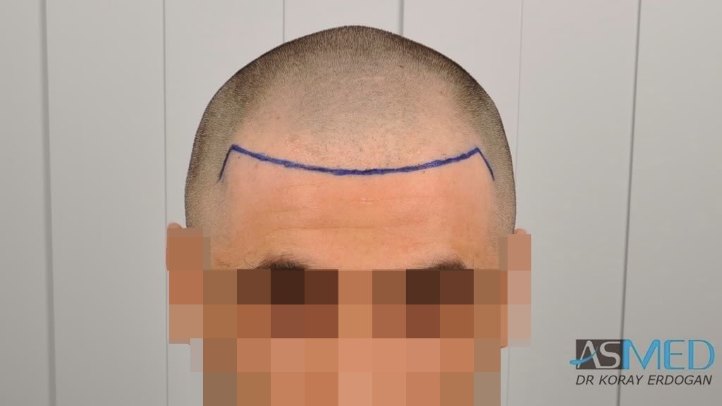 Norwood3 2100-grafts-FUE 50abf610