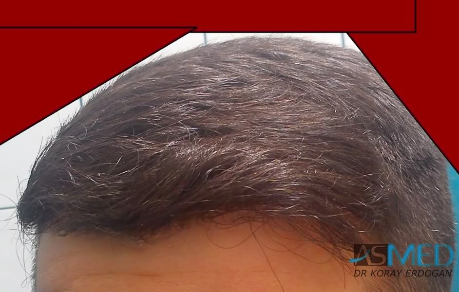 Norwood3 2100-grafts-FUE 607331ca