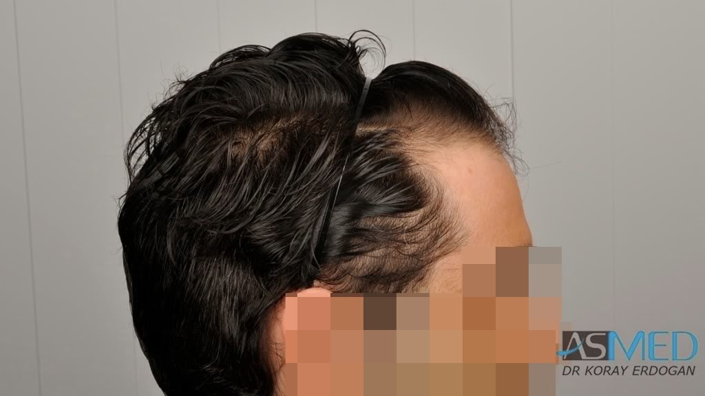 Norwood3 2100-grafts-FUE 94ece991