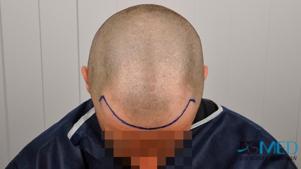 Norwood3 2100-grafts-FUE 9664a073