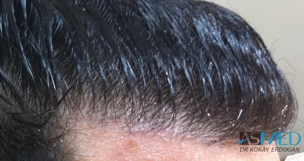 Norwood3 2100-grafts-FUE 9f29914c