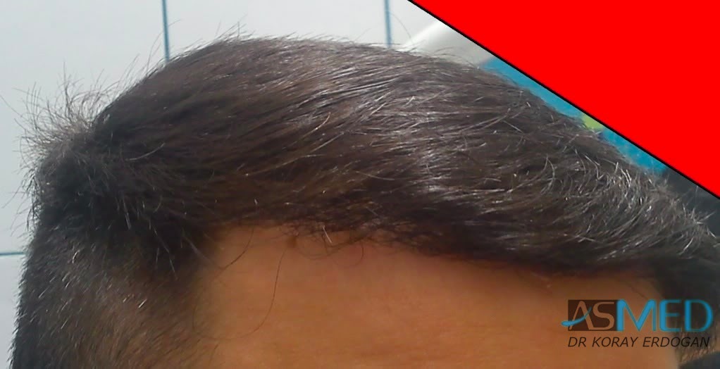 Norwood3 2100-grafts-FUE b2772b1f