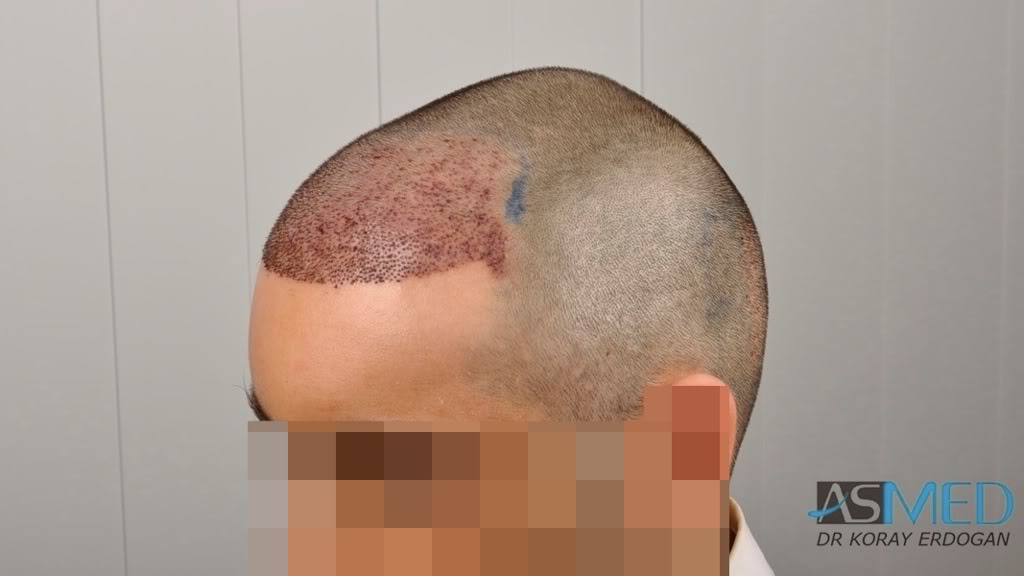Norwood3 2100-grafts-FUE b27a2359