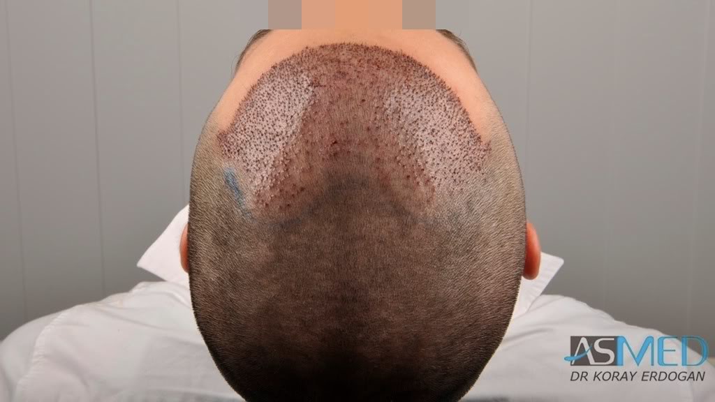 Norwood3 2100-grafts-FUE bea0bb4f