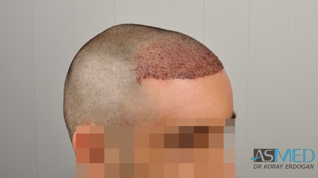 Norwood3 2100-grafts-FUE d6f92a8a