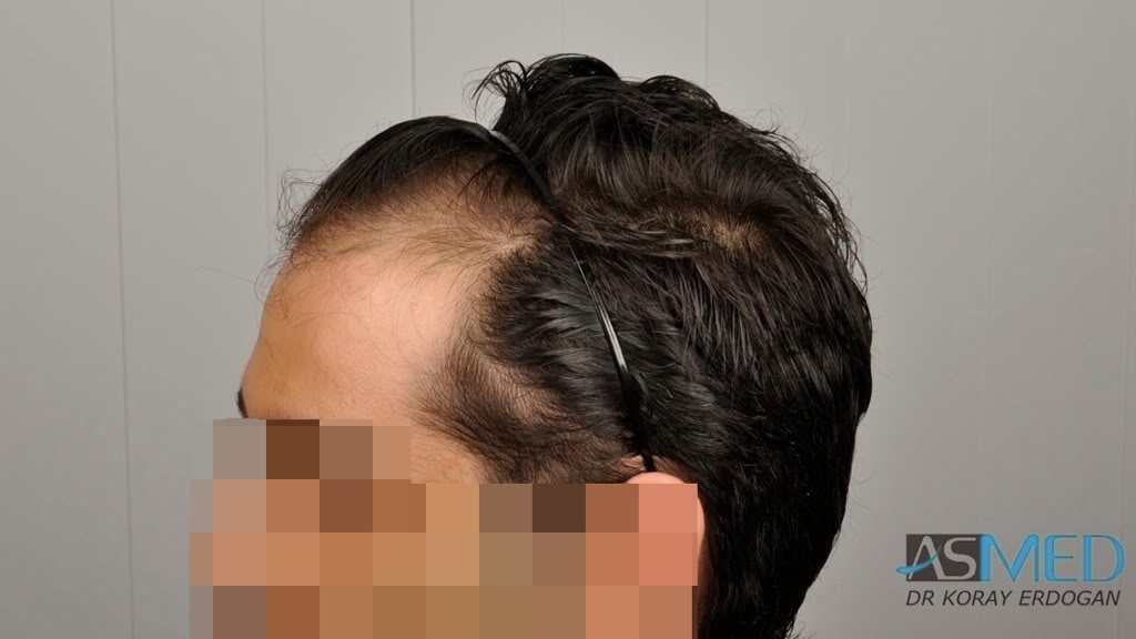 Norwood3 2100-grafts-FUE d996e4cb