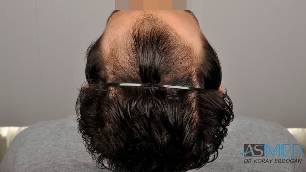 Norwood3 2100-grafts-FUE e0596bd7