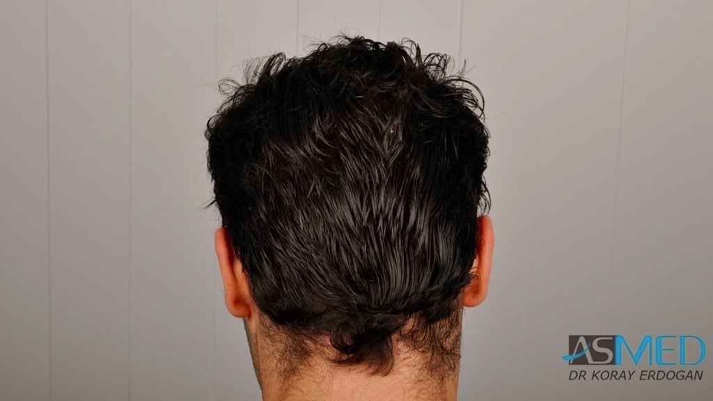 Norwood3 2100-grafts-FUE e2235c4b