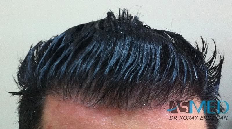 Norwood3 2100-grafts-FUE e60d6b36