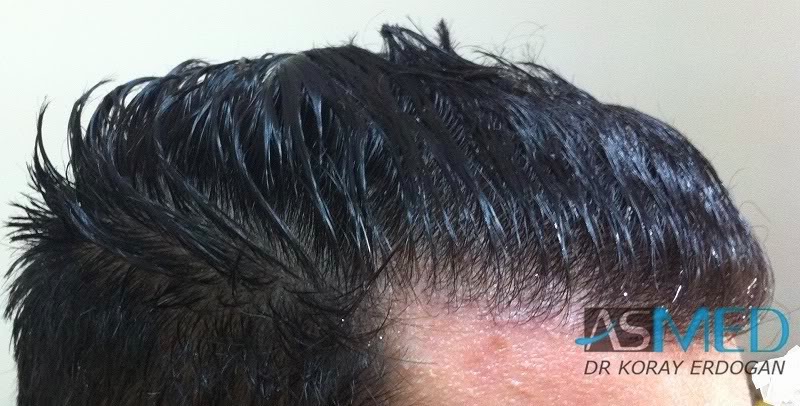 Norwood3 2100-grafts-FUE e880a5c2