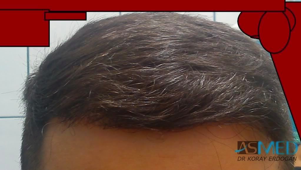 Norwood3 2100-grafts-FUE ed1994af