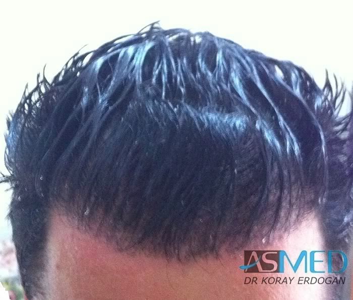 Norwood3 2100-grafts-FUE f436951d