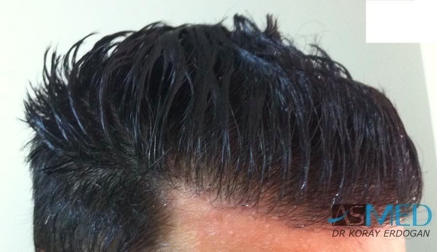 Norwood3 2100-grafts-FUE ff6a8aa9