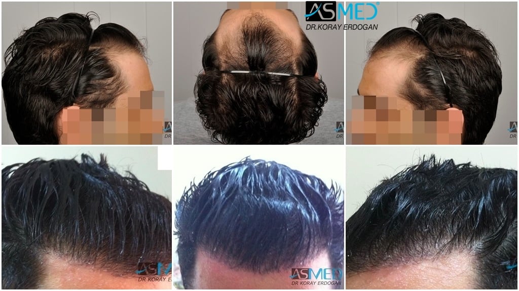2100-grafts-FUE gallery