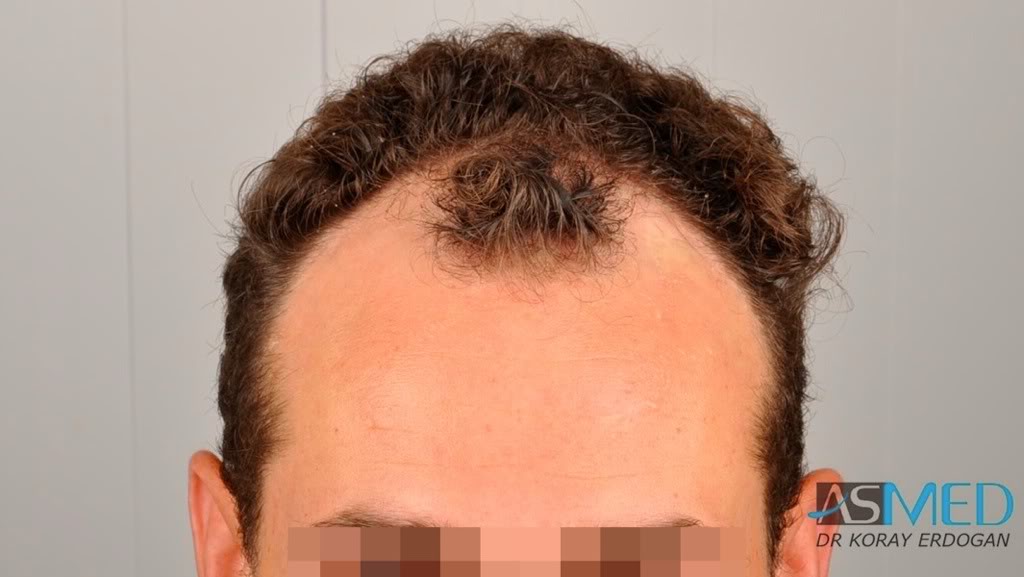 Norwood3 2300-grafts-FUE 00c04d84