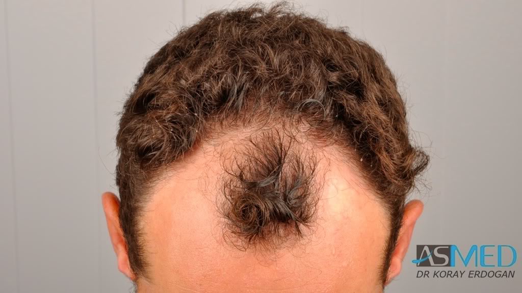 Norwood3 2300-grafts-FUE 3071abf5